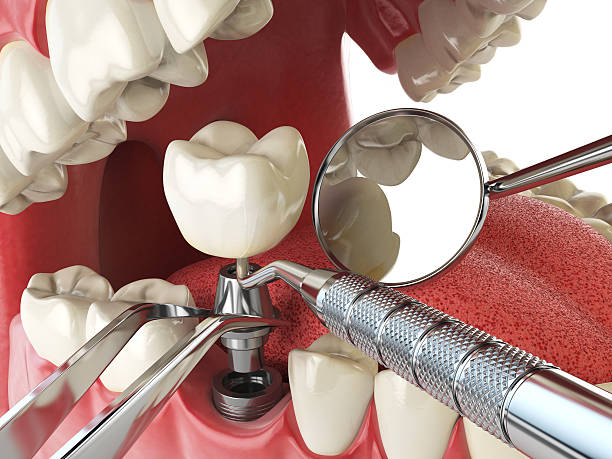 Best Emergency Wisdom Tooth Extraction in Forestville, MD